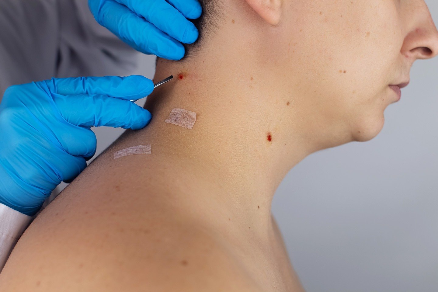 Skin Bridge Excision care-well